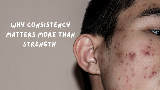 Skincare for Acne-Prone, Sensitive Skin - Why Consistency Matters More Than Strength