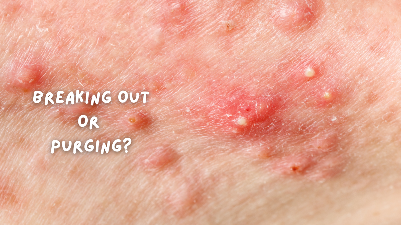 Break In Skin Skin Purging or Breaking Out? Understand the Difference | Earthwoven
