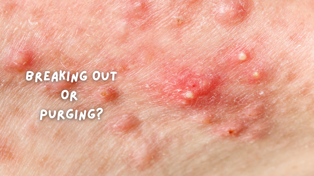Skin Purging or Breaking Out? How to Tell the Difference