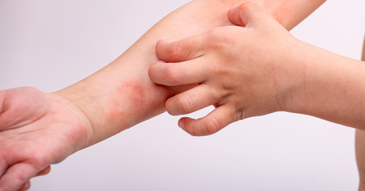 Baby with eczema on arm scratching itchy, red skin – common symptom of atopic dermatitis