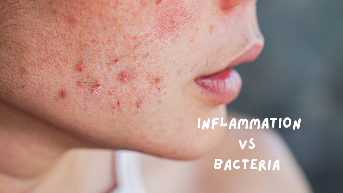 Your Breakouts Aren’t Always Bacterial! Sometimes It’s Inflammation...