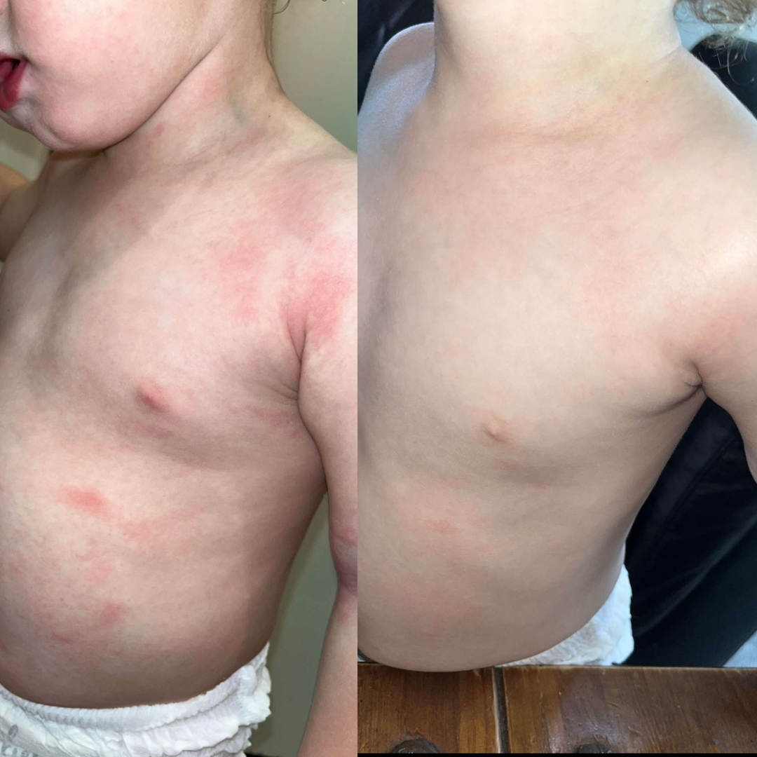 nitial skin showing significant redness due to eczema. Earthwoven Treatment Noticeable reduction in redness and irritation, promoting calmer skin